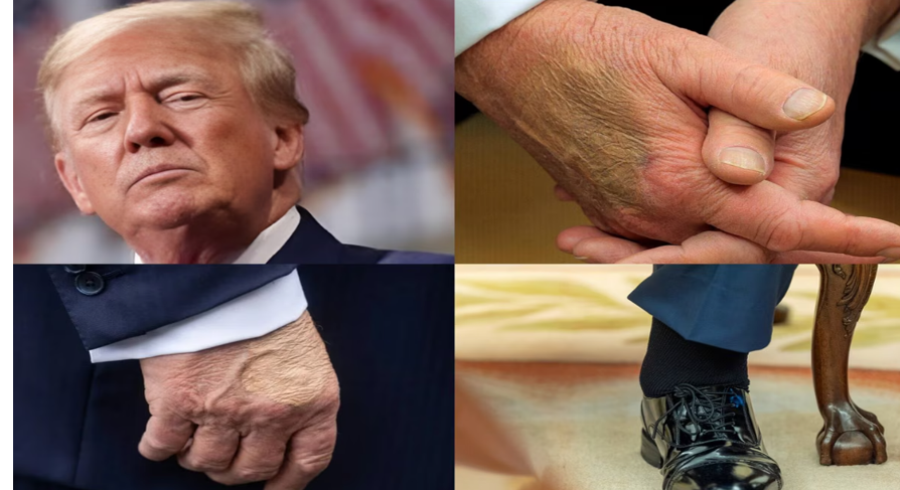 डोनाल्ड ट्रंप की वायरल तस्वीरों से उठा स्वास्थ्य पर सवाल: वाइट हाउस ने मेडिकल रिपोर्ट जारी कर दी सफाई